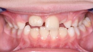 fixing cross bite with braces orthodontics