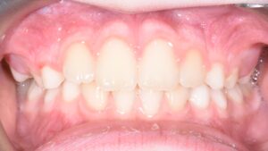 fixing cross bite with braces orthodontics