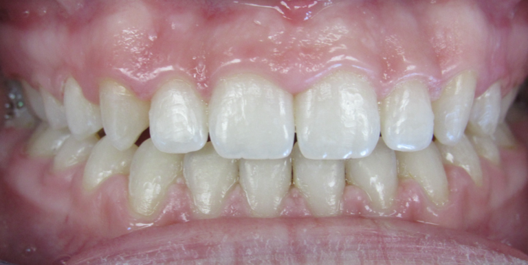 closing gaps between teeth