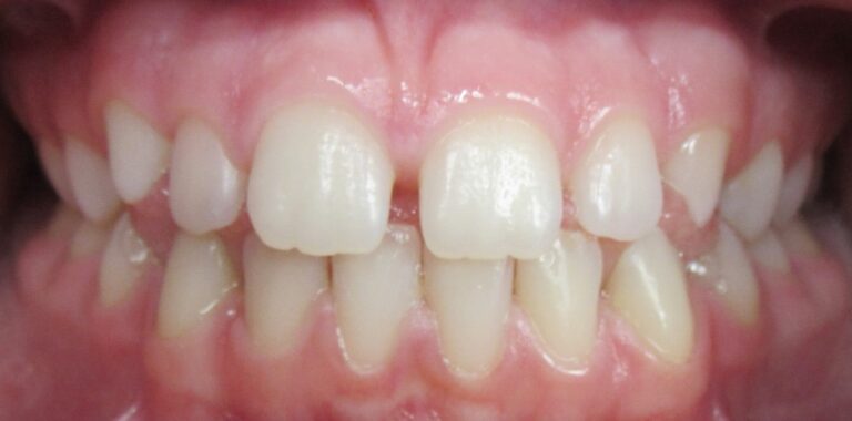 closing gaps between teeth