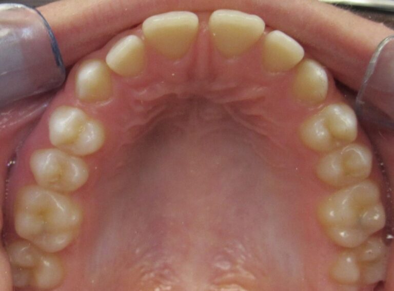 spaces between teeth