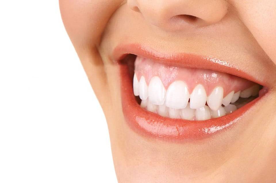fixing a gummy smile with orthodontics