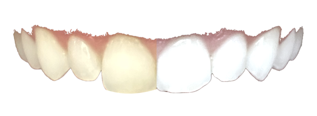 whitening after braces or invisalign